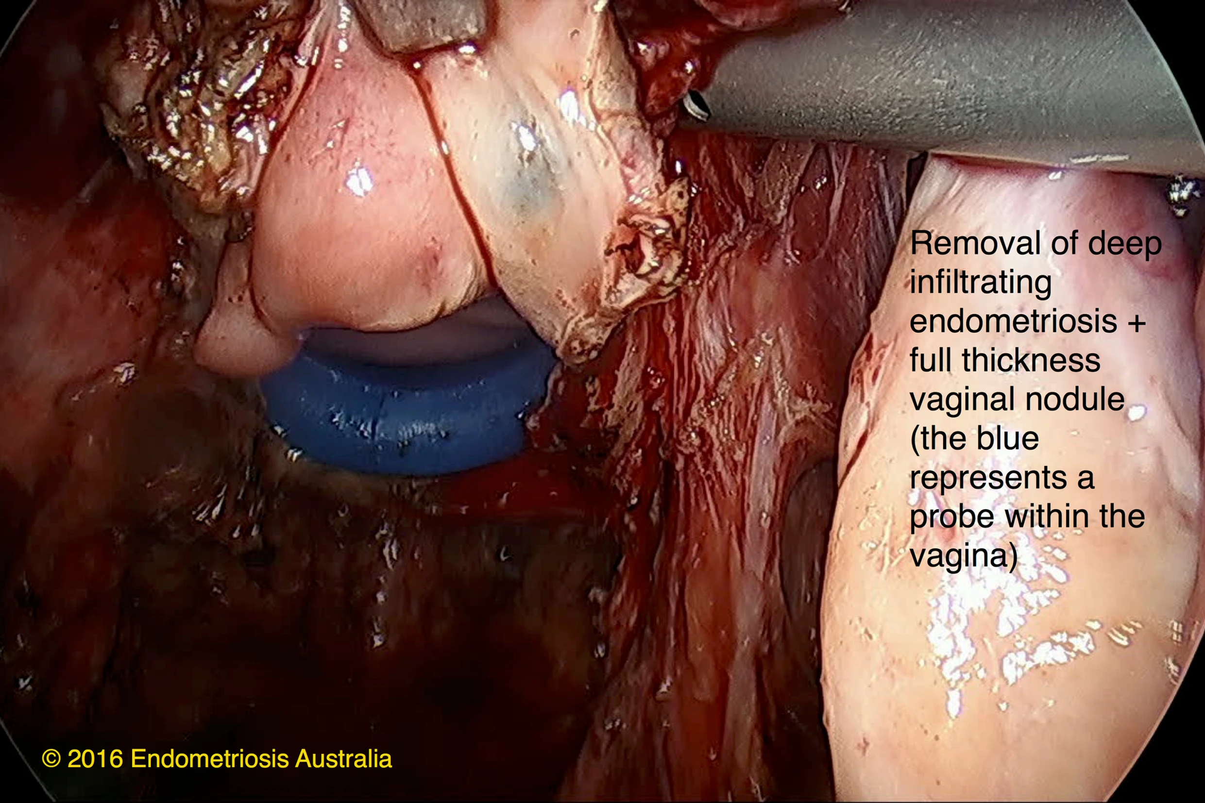 Removal of deep infiltrating endometriosis and full thickness vaginal nodule (the blue represents a probe within the vagina)