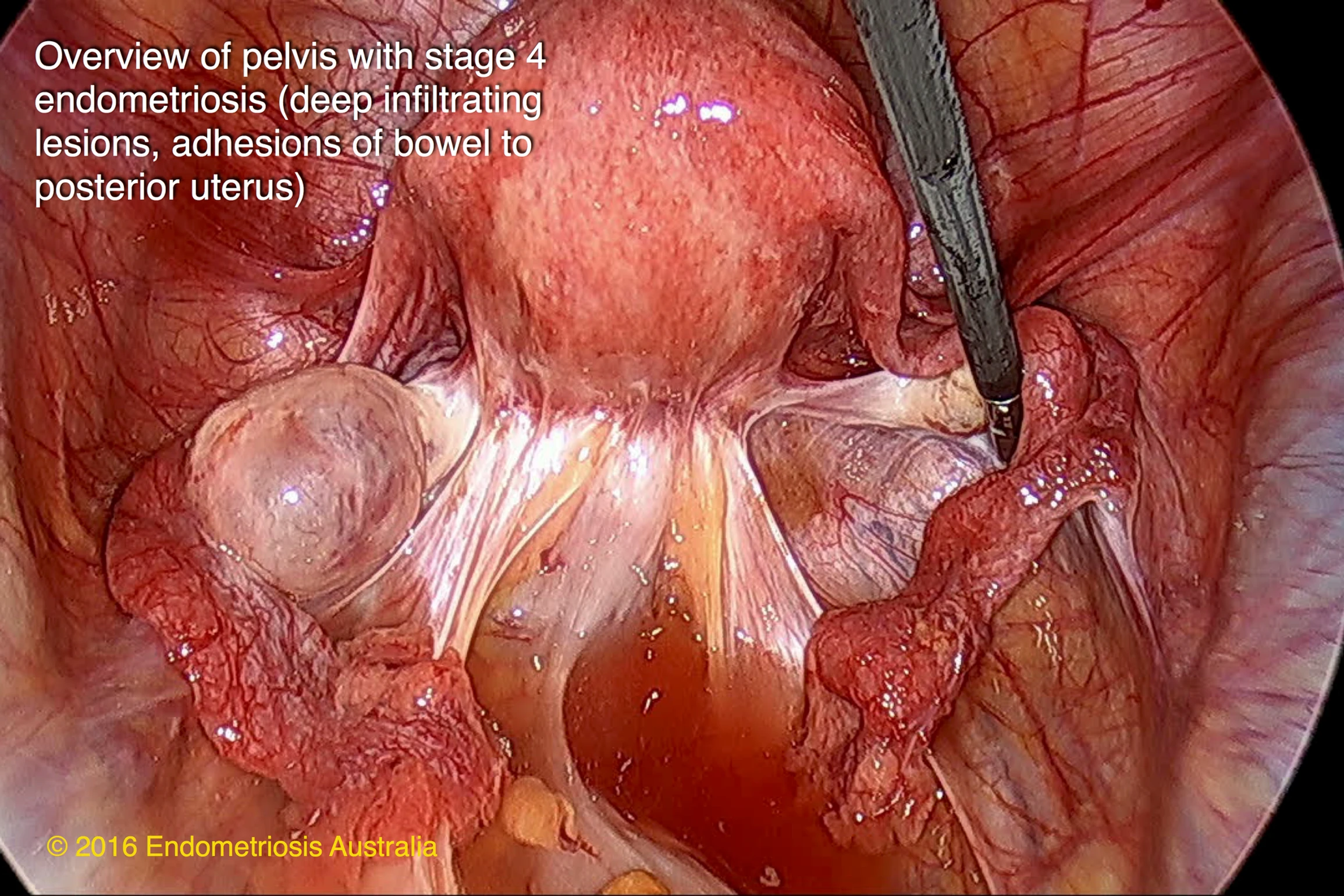 Overview of pelvis with stage 4 endometriosis (deep infiltrating lesions, adhesions of bowl to posterior uterus )