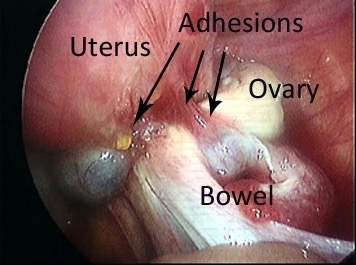vagina, bowel and bladder