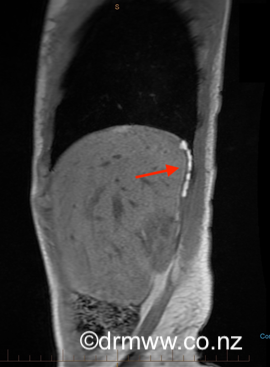 Posterior diaphragmatic endometriosis seen on MRI as white spots