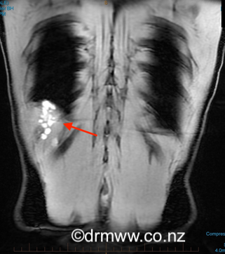 Posterior diaphragmatic endometriosis seen on MRI as white spots