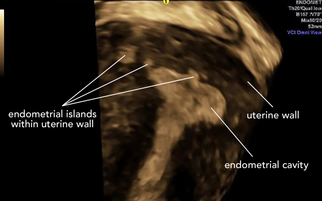 Adenomyosis – Sister to endometriosis or distant cousin?