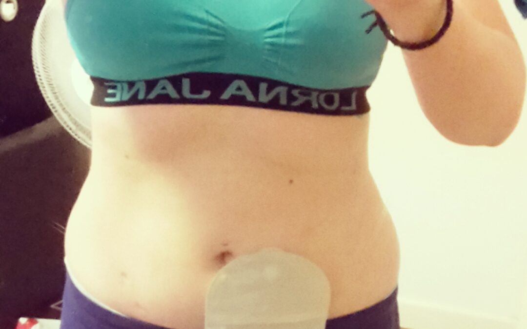 I wound up with an ostomy because of endo