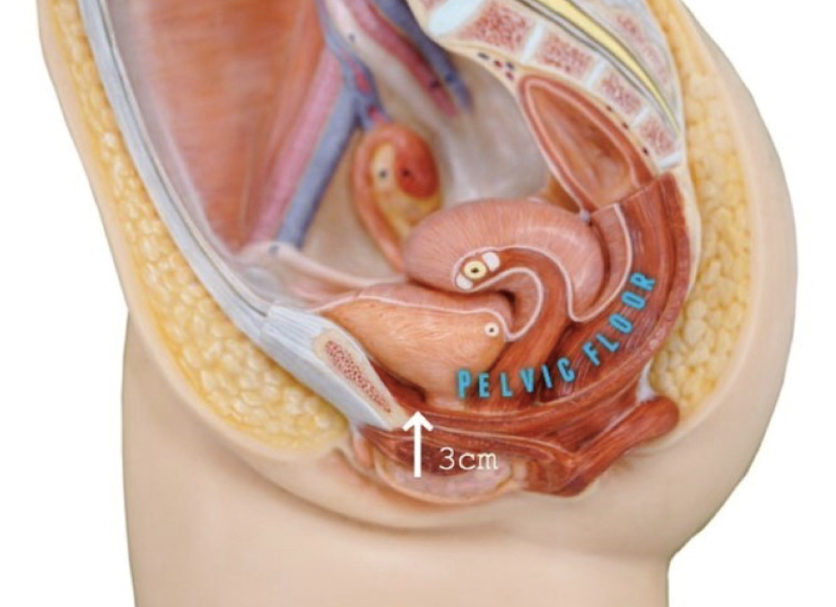 Overactive pelvic floor muscles in endometriosis