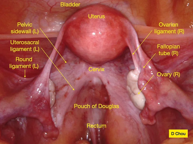 Anatomy 101 for surgical removal of endometriosis - Endometriosis Australia