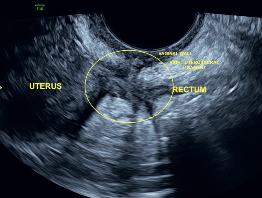 transvaginal ultrasound image showing a nodule of deep endometriosis